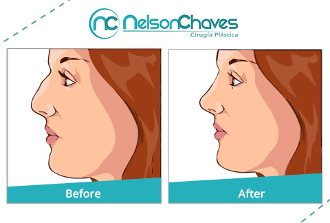 Before and After of Rhinoplasty