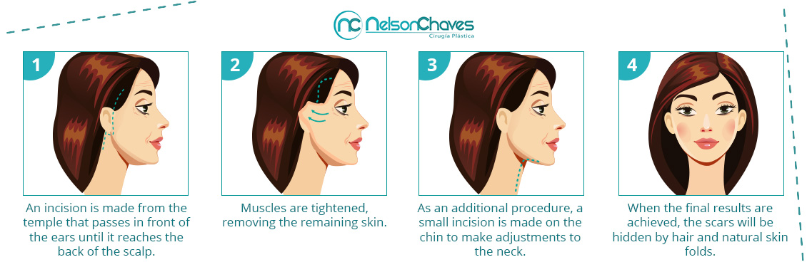 Facial Rhytidoplasty