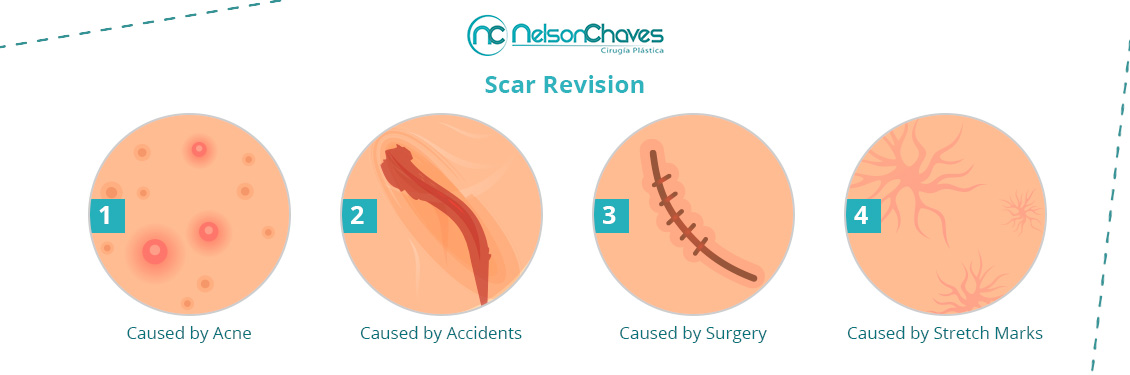 Scar Revision