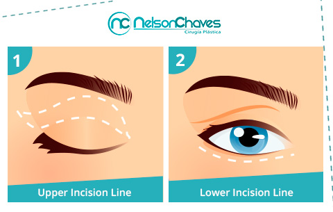 Before and After an Eyelid Surgery Eyelid Surgery