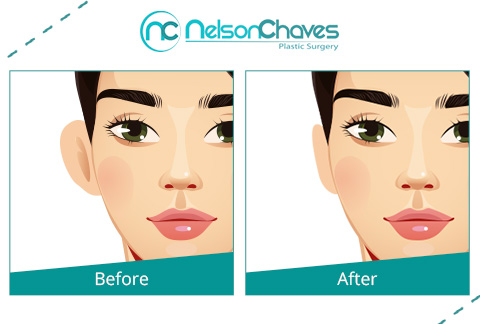 This Procedure is Also Called Otoplasty Before and After an Ear Surgery