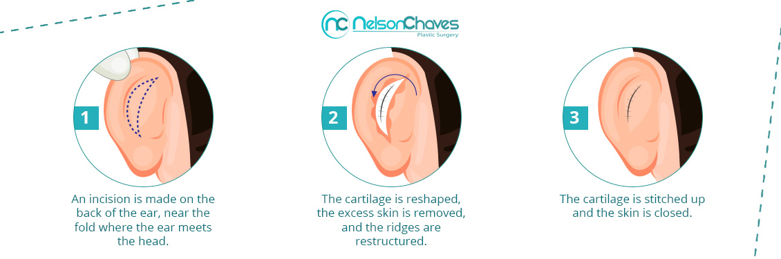 Ear Surgery Procedure