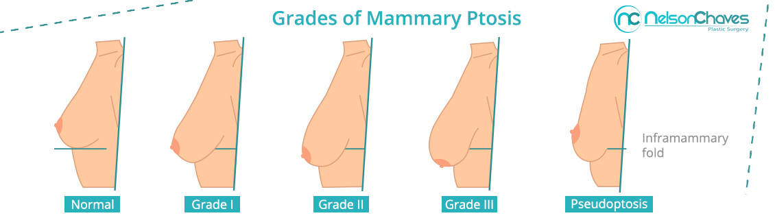 Breast Lift with or without Implants