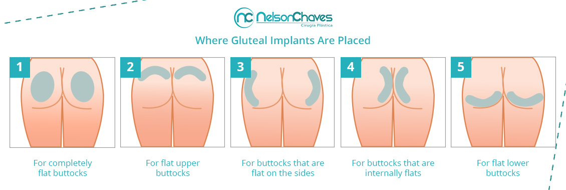 Gluteal Augmentation