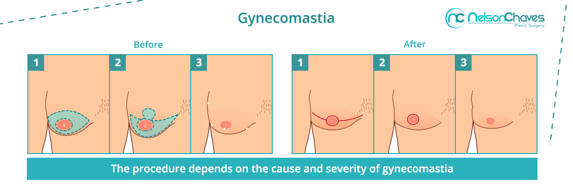 Male Breast Reduction Procedure