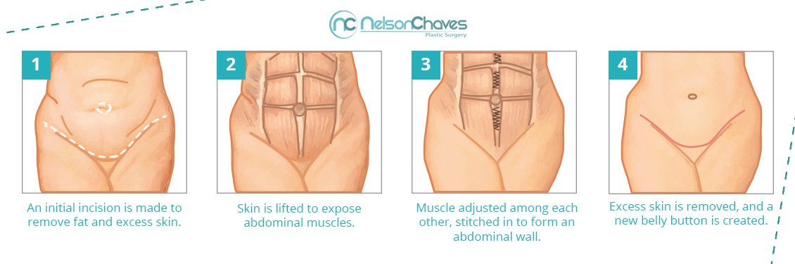 Abdominal Lipectomy Procedure