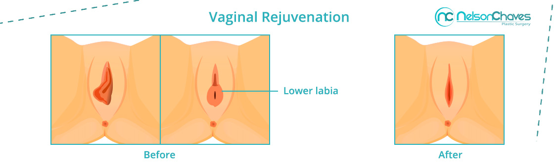 surgery vaginal reconstructive Surgery vaginal reconstructive
