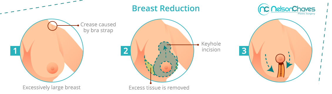Breast Reduction Procedure