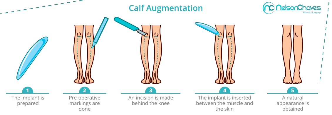 Calf Augmentation Procedure