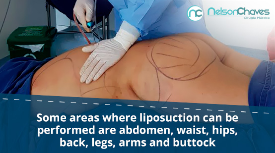 Liposuction in Colombia by a Plastic Surgeon