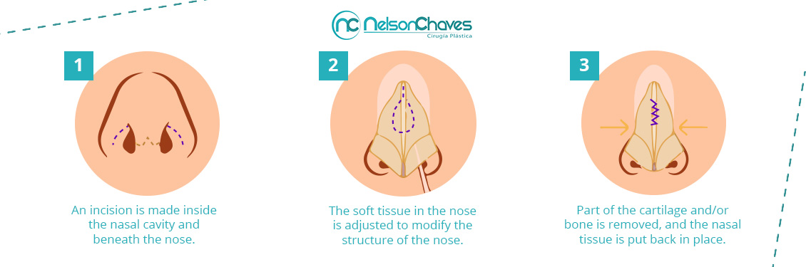 Nose Surgery