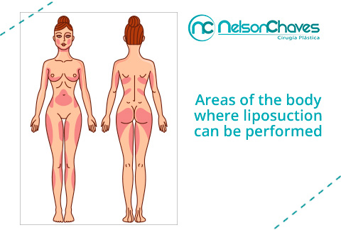 Areas for Liposuction