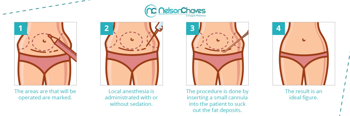 Liposuction Procedure